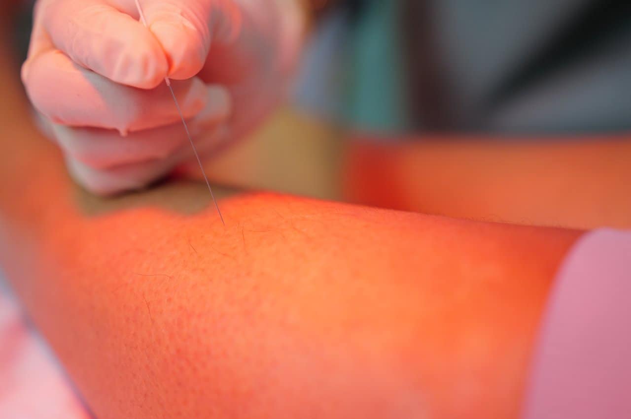 Physiotherapy Dry Needling Closeup Needle Insertion Leg Muscle Treatment - integrative healthcare treatment at Healers Clinic Dubai