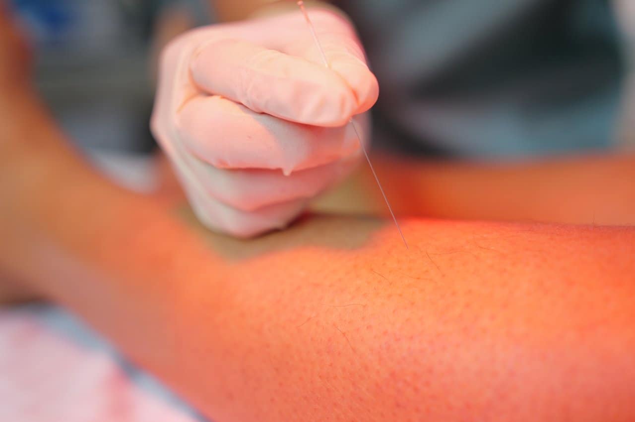 Physiotherapy Dry Needling Precise Needle Insertion Trigger Point Therapy - integrative healthcare treatment at Healers Clinic Dubai