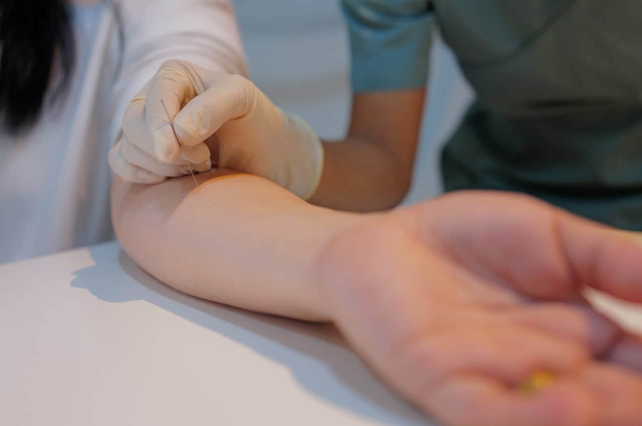 Physiotherapy Dry Needling Session - integrative healthcare treatment at Healers Clinic Dubai