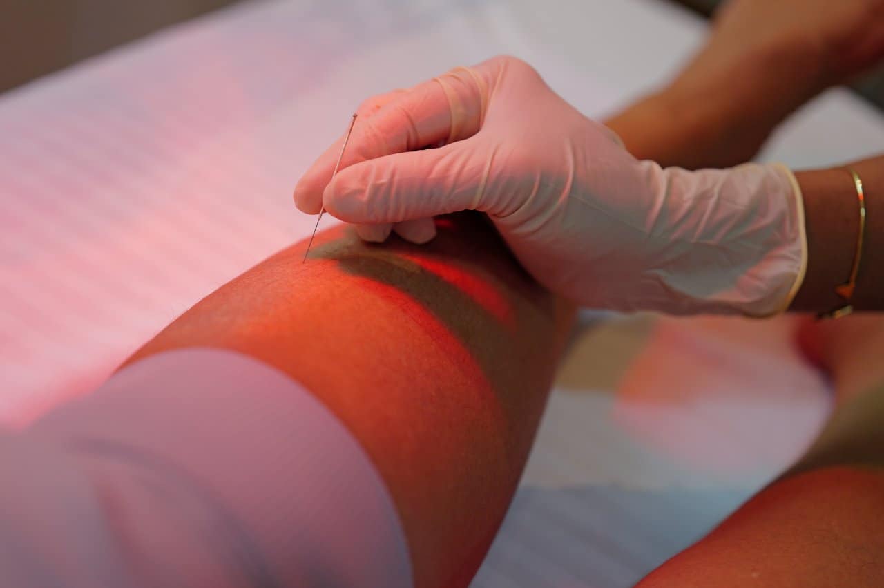 Physiotherapy Dry Needling Thigh Muscle Treatment Reaction Marks Petechiae - integrative healthcare treatment at Healers Clinic Dubai