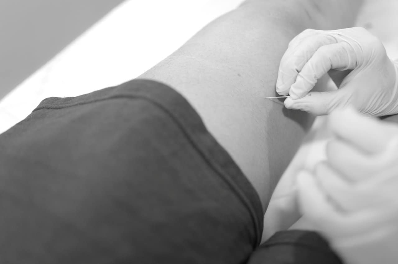 Physiotherapy Dry Needling Treatment Leg Muscle Black White Clinical - integrative healthcare treatment at Healers Clinic Dubai
