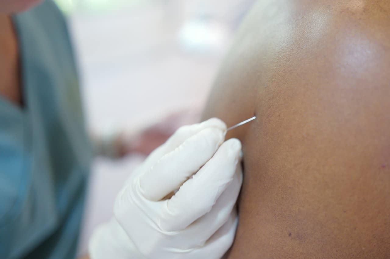 Physiotherapy Dry Needling Treatment Shoulder Needle Insertion Therapy - integrative healthcare treatment at Healers Clinic Dubai