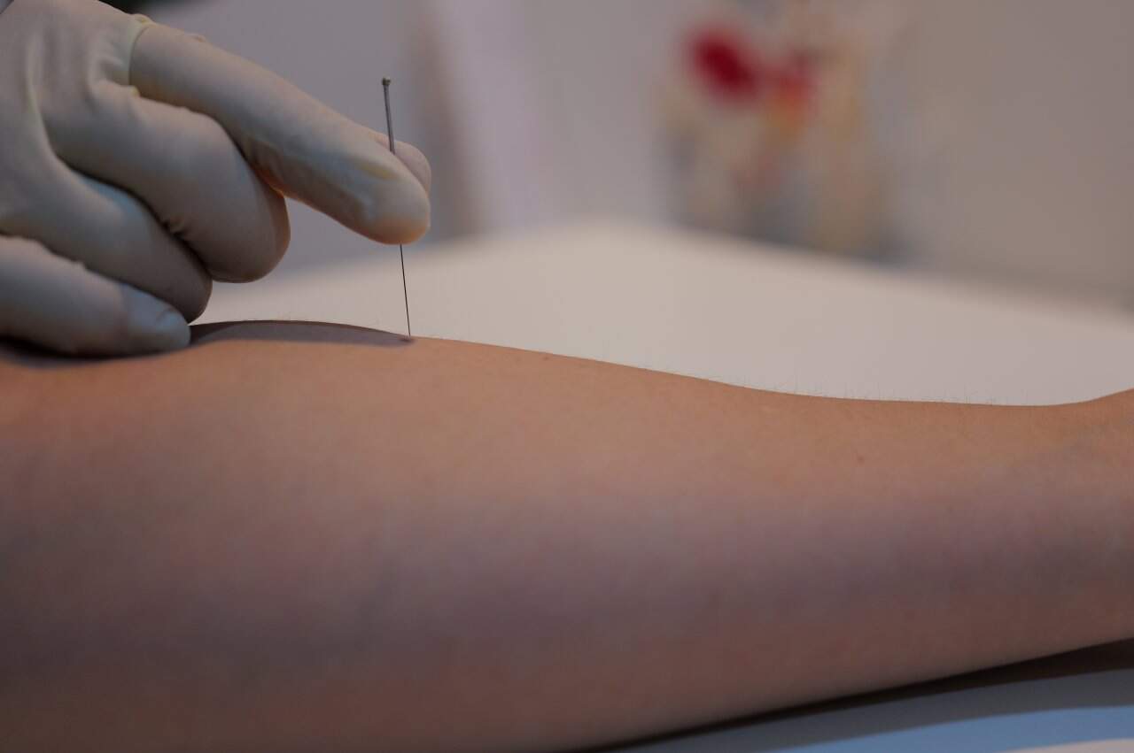 Physiotherapy Dry Needling Treatment - integrative healthcare treatment at Healers Clinic Dubai
