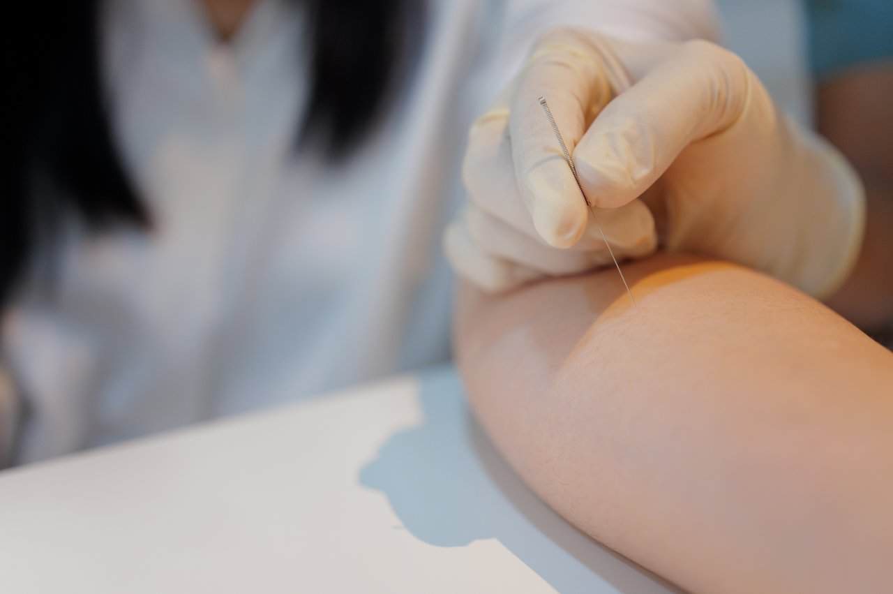 Physiotherapy Needle Therapy Patient - integrative healthcare treatment at Healers Clinic Dubai